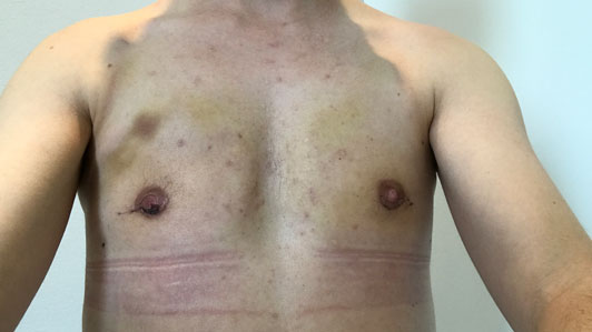 Transkønnet, mastektomi - Helingsprocessen Rigshospitalet 2017