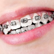 silver-black-braces