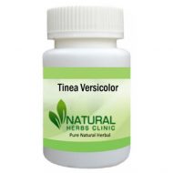 Herbal Products for Tinea Versicolor