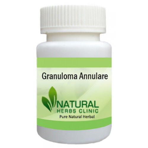 Home Remedies for Granuloma Cancel