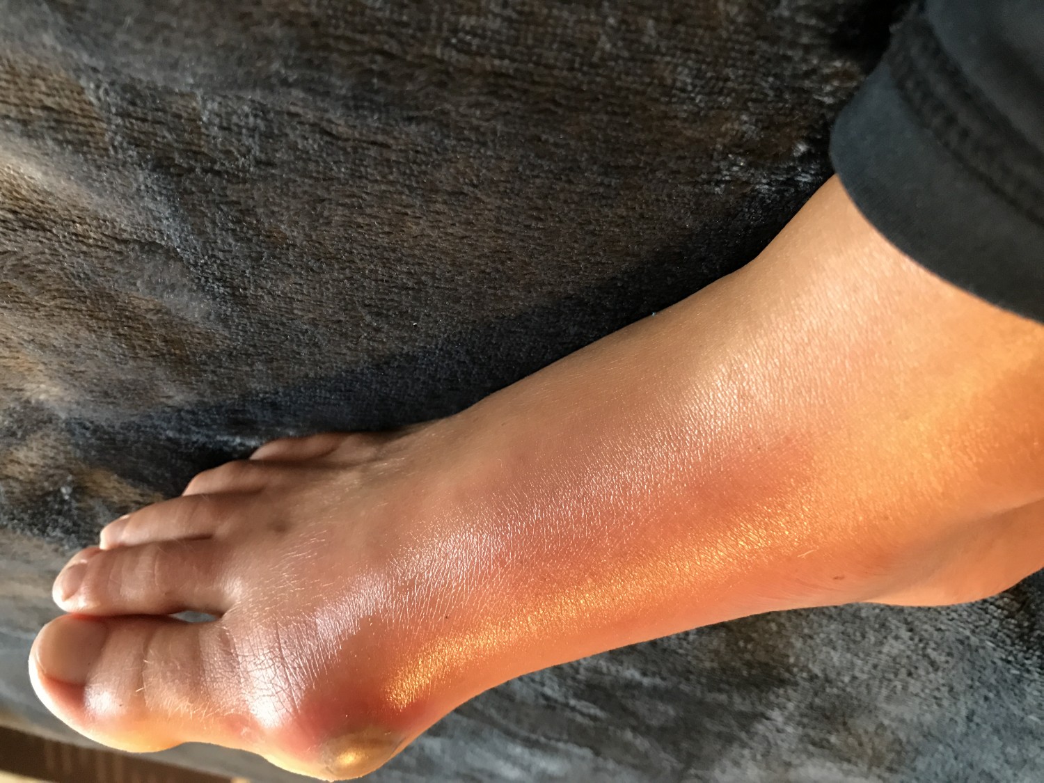 Tips og fod-øvelser til knyster på fødderne/hallux vagus | Sissel Møller