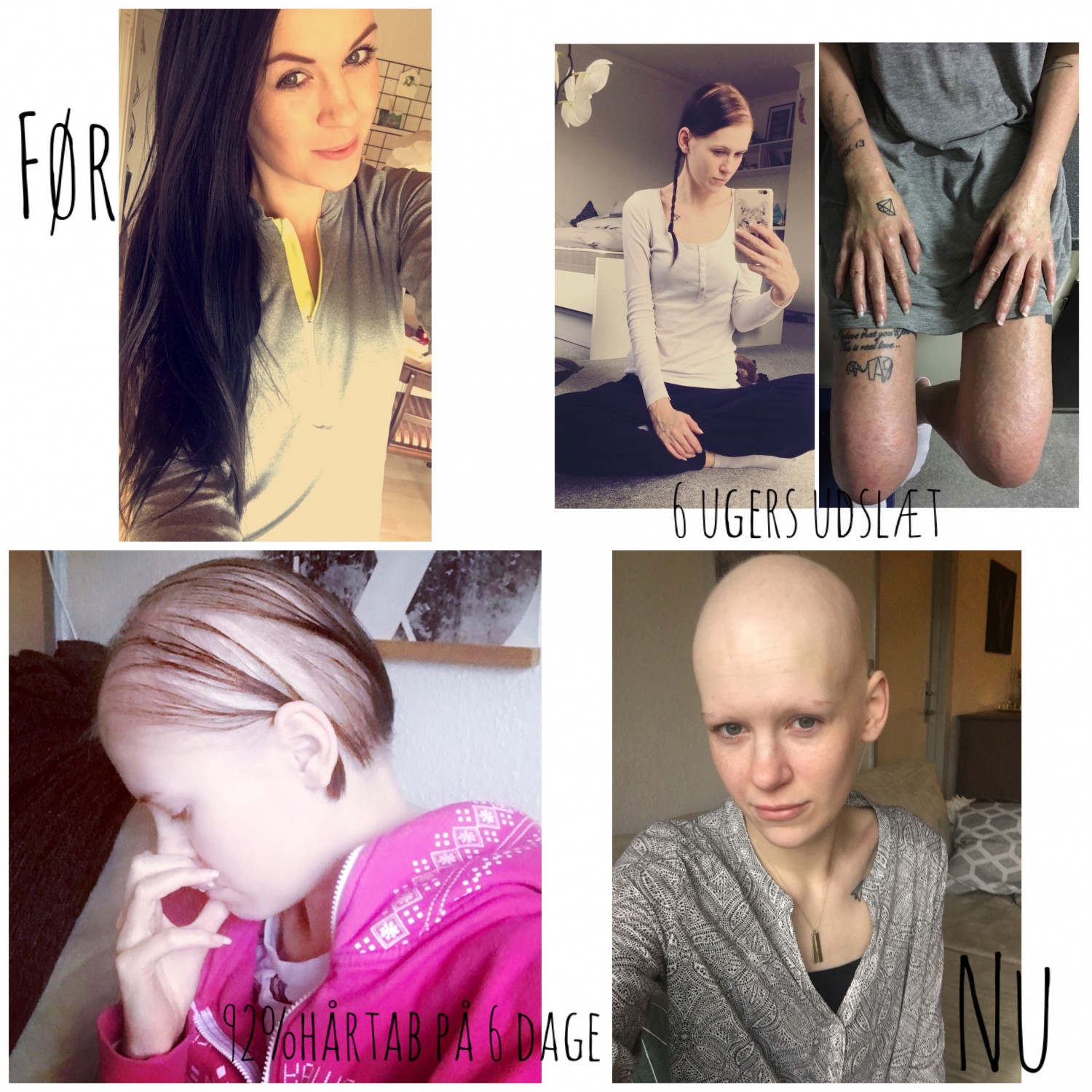 En autoimmunsygdom – kronisk syg for livet | Alopecia Areata | Kalitetstid