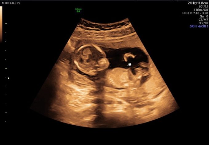 Gravid pige eller dreng
