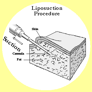 liposuction proc