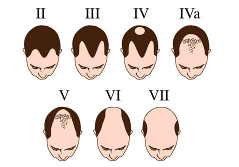 hair-loss-stages