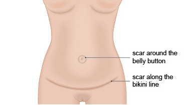 what-does-an-abdominoplasty-scar-look-like-tummy-tuck-brisbane