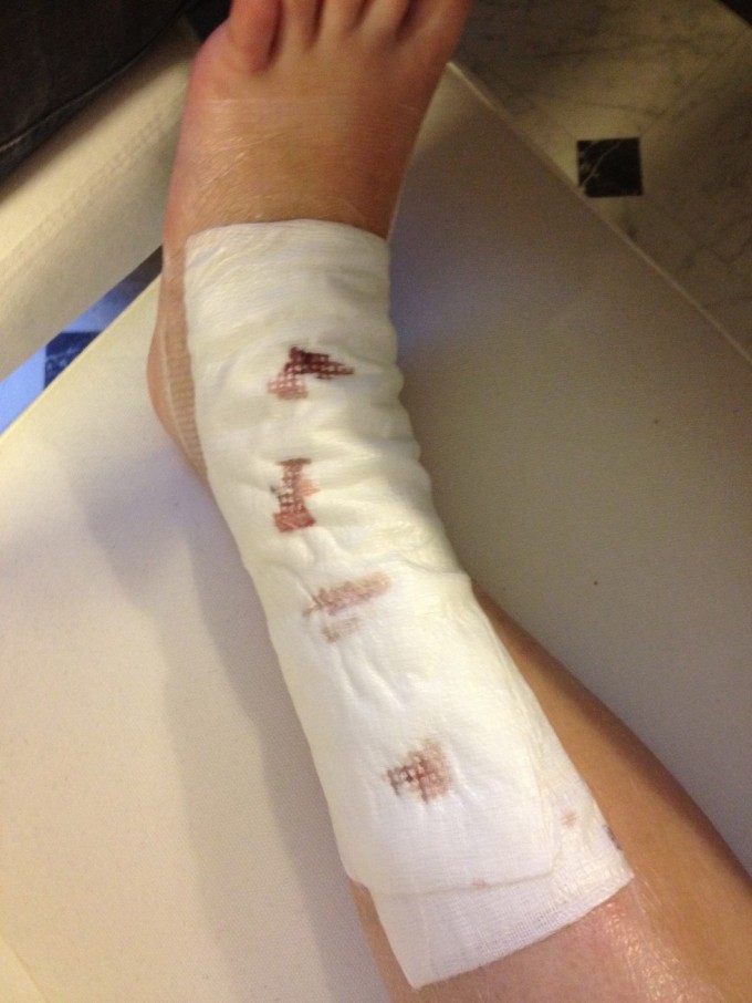 Den vat-forbinding jeg fik på benet lige efter operationen.