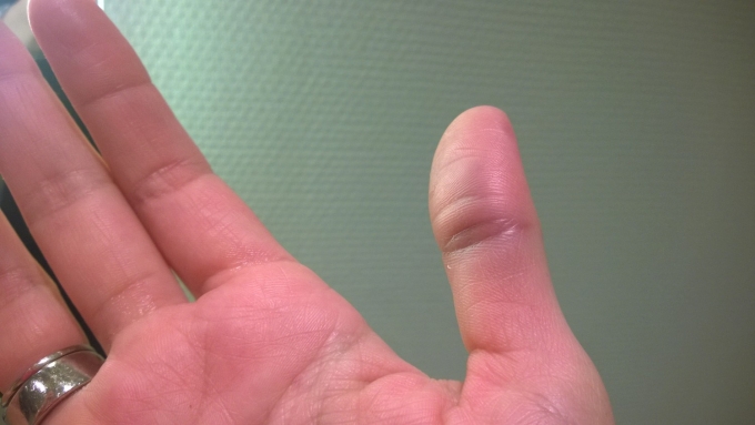 Ja, det er et billede af min højre tommelfinger, som har fået en nydelig blålig farve efter min håndflades møde med en væg.