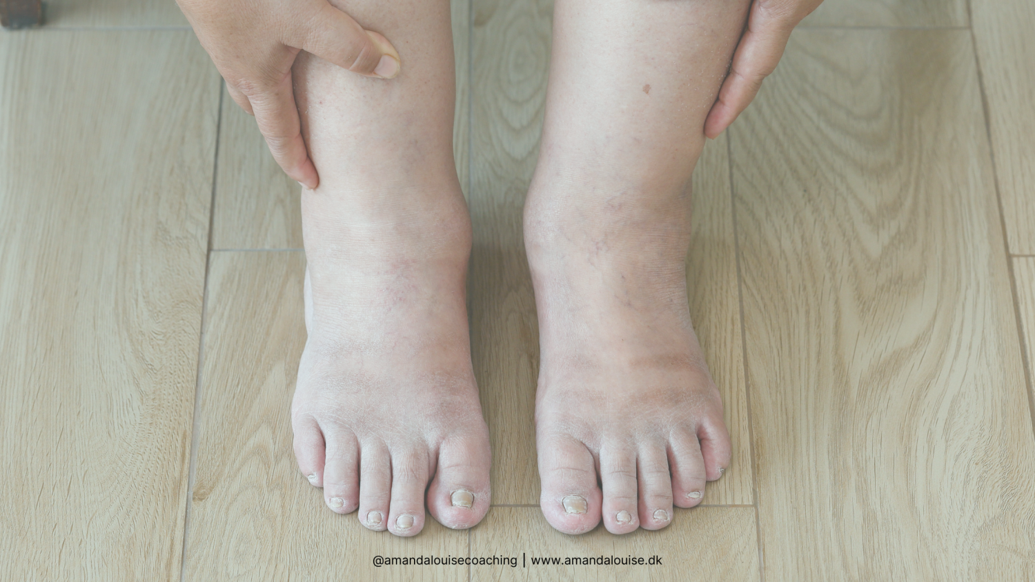 Fysioterapeutens 4 gode råd mod vand i benene | VÆGTNEUTRAL SUNDHED |  Amanda Louise