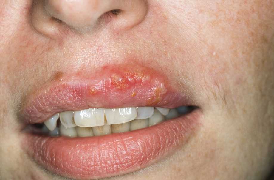 Ikke forkølelsessår sår på læben Forkølelsessår: årsager,