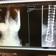 Min ryg før og efter operatioen :-) IRON LADY ;-)