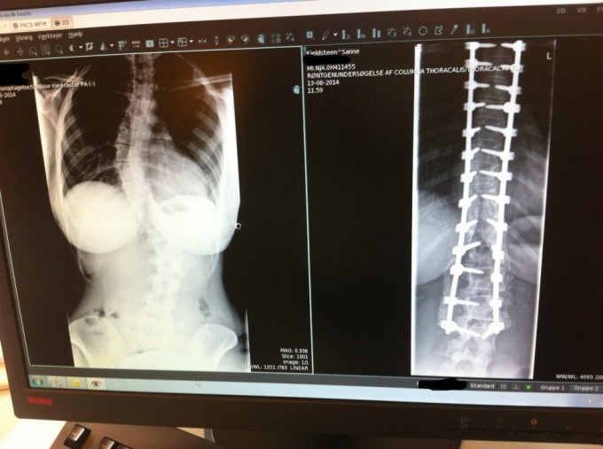 Min ryg før og efter operatioen :-) IRON LADY ;-)